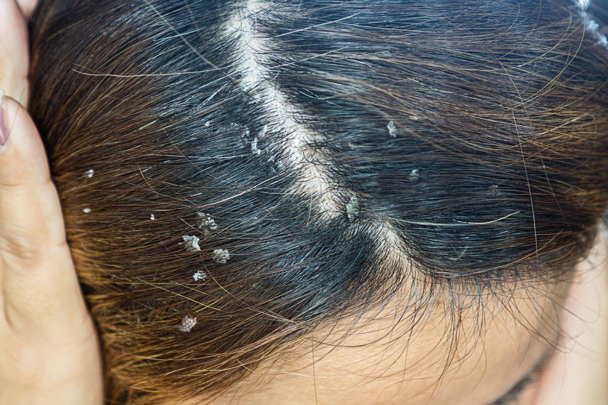 Can Seborrheic Dermatitis Cause Hair Loss Noophoric